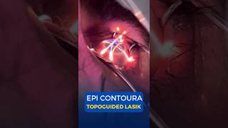 EPI Contoura Topoguided Lasik Surgery [upl. by Aidnyl]