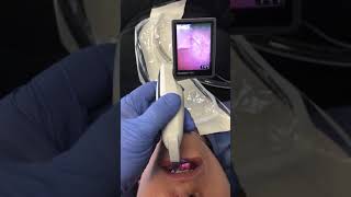 Video Laryngoscopy [upl. by Kristine354]