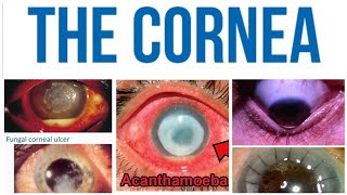 Cornea 8 Major Topic Herpes Zoster Ophthalmicus [upl. by Arak966]