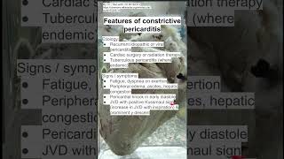 Features of constrictive pericarditis [upl. by Altis844]