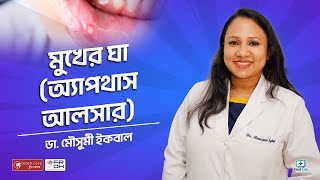 মুখের ঘা অ্যাপথাস আলসার Aphthous ulcer treatment bangla [upl. by Lacym]