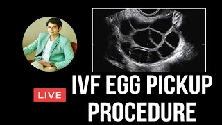 IVF Procedure Step by Step Animation [upl. by Yziar]