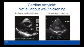 Cardiac Amyloidosis Webinar [upl. by Assecnirp699]