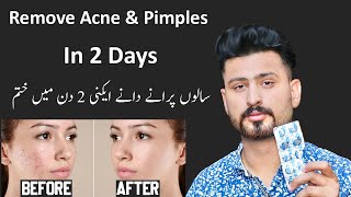 Best Treatment For Remove Pimple amp Acne In 2 Days  Pimples Removal Permanent On Face at Home [upl. by Audra670]