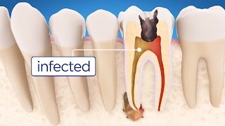 Root Canal Treatment Step by Step [upl. by Lehte]