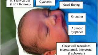 Hyaline membrane diseaserisk factor clinical features sign and symptoms [upl. by Sinclare420]