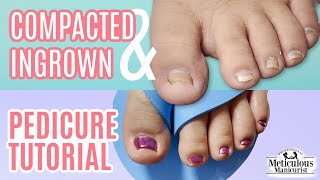 👣Pedicure Tutorial on Deep Compacted Ingrown Big Toenail👣 [upl. by Airehs]