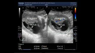 Ultrasound Video showing Missed abortionMissed miscarriage [upl. by Tirrag]