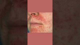 Why Your Perioral Dermatitis Won’t Heal dermatologist [upl. by Tombaugh345]