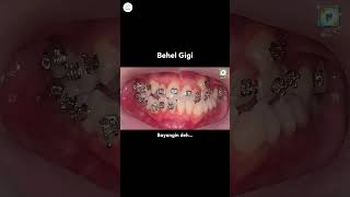 Tau gak solusi mau punya gigi rapih tuh ya Pasang behel solusinya 🥰 dentist behelgigi [upl. by Nevada]