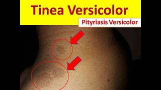 Tinea Versicolor in Young People  Pityriasis Versicolor [upl. by Meras]