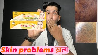 Herbal acne cream  Herbal acne cream review  Herbal acne cream uses  herbal acne cream ke fayde [upl. by Astiram]