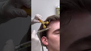 PRP treatment for hair thinning [upl. by Eliades]