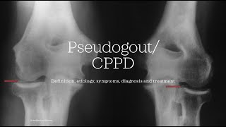 Pseudogout  CPPD Calcium pyrophosphate deposition disease Essential medicine [upl. by Allimaj76]