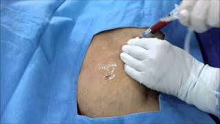 Ultrasound Guided Axillary vein Catheterization [upl. by Storm]