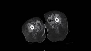 CT Abdomen showing Diverticulitis with pneumoperitoneum [upl. by Favrot]