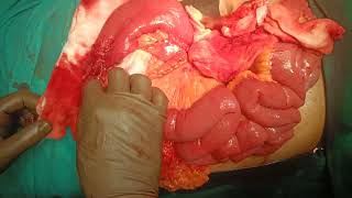 ischemic jejunal stricturedue to portal vein thrombosis [upl. by Aoh]