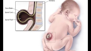 Neural Tube Defects [upl. by Nilved481]