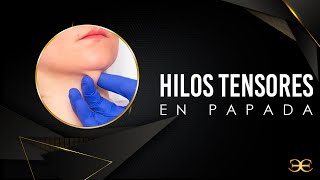 HILOS TENSORES EN PAPADA  Dr Jorge de León [upl. by Adnohs]