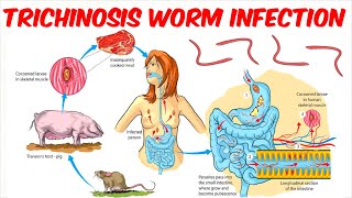 Trichinosis Trichinellosis Worm Infection [upl. by Ahselat]