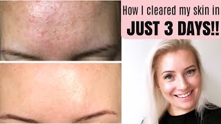 GET RID OF TINY BUMPS ON FOREHEAD FAST  HOW TO TREAT FUNGAL ACNE MALASSEZIA  BEING MRS DUDLEY [upl. by Norrek683]