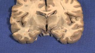 Hypothalamus Neuroanatomy Video Lab  Brain Dissections [upl. by Anayrb]