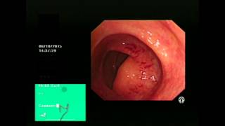 Colonic Angiodysplasia and APC treatment [upl. by Ahsilad735]