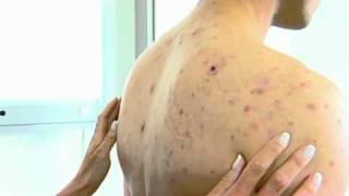 Acne NYC  212 6449494 NYC Cystic Acne Back  Pimples NYC  Acne Face NYC [upl. by Eva875]