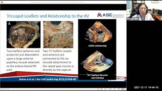 Part 2 Guidelines and Review of Tricuspid and Interatrial SeptumLAA Imaging Protocols [upl. by Andrew]