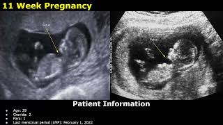 First Trimester Pregnancy Ultrasound Reporting  Obstetric USG Scan Reports  512 Weeks Fetal USG [upl. by Matthei228]