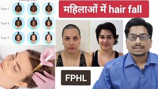 महिलाओं में hair fall  Female Pattern Hair loss Androgenetic Alopecia hairlosstreatment alopecia [upl. by Anecuza]