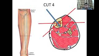 Safe Zones for wires amp pins tibia  Dr Rajiv Gupta [upl. by Assyl]