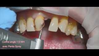 Anterior esthetic crown Distribué par DentalPAG [upl. by Stasny875]