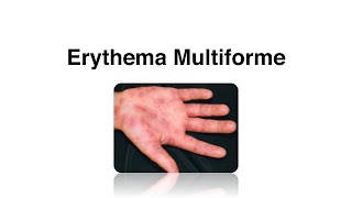 Erythema Multiforme  Causes Complications amp Treatment [upl. by Orteip]