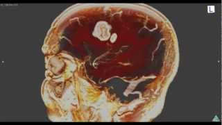 Brain Tumor 3D MRI：脳腫瘍を造影してみた [upl. by Nolyd]