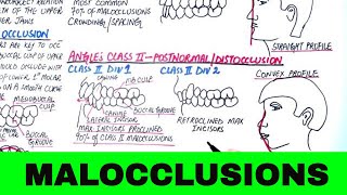 Angles Classification of Malocclusion  Orthodontics [upl. by Ahsenwahs95]