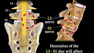 Low Back Pain  Disc Herniation Sciatica  Everything You Need To Know  Dr Nabil Ebraheim [upl. by Enilegnave]