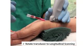 ULTRASOUND GUIDED RADIAL ARTERY PT CHUI [upl. by Deeas]