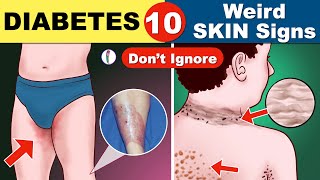 Diabetes skin signs  Diabetes symptoms  Signs of Diabetes  Diabetes mellitus  Type 1 diabetes [upl. by Kai]