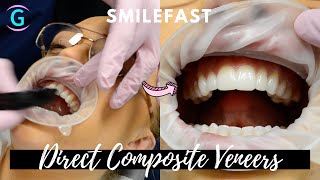 Direct Composite Veneers  SMILEFAST TRANSFORMATION [upl. by Aztiram]