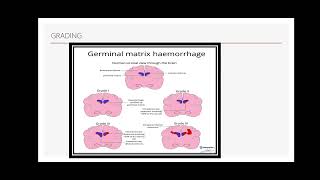 Intraventricular haemorrhage ivh germinal matrix hemorrhage Periventricular leucomalcia [upl. by Jepson]