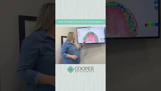 How To Read Colors On An Occlusalgram  Orthodontist for Teens and Adults  Houston TX [upl. by Ivatts]