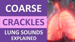 Coarse Crackles Lung Sounds Audio Causes Auscultation Nursing NCLEX Review [upl. by Hermann609]