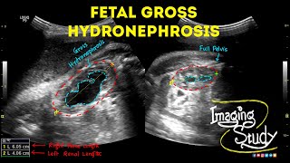 Fetal Unilateral Hydronephrosis  Ultrasound  Anomaly  Case 44 [upl. by Zehcnas]