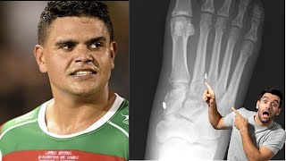 Latrell Mitchell LISFRANC FOOT INJURY Explained Will he need SURGERY [upl. by Fatimah44]