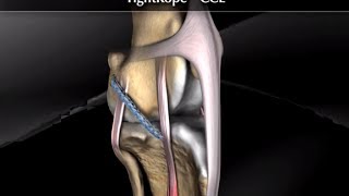 TightRope Cruciate Ligament Surgery using Arthrex Tightrope CCL [upl. by Codd]