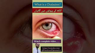 Chalazion  Meibomian Cyst  Eyelid Cyst  Practice Of Optometry  Eye Exam  Eye Lump  Eye Pain [upl. by Notsob333]