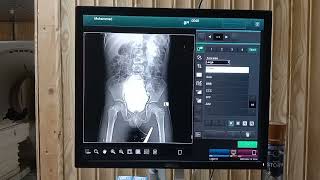 MCUG  micturating cystourethrogram procedure  mcug x ray  easy way to perform mcug x ray [upl. by Fabien]