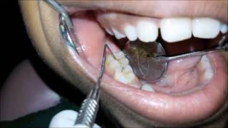 Indication tooth preparation and application of Pit and Fissue Sealants [upl. by Anderson996]