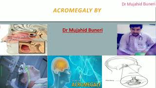 Achieve Mastery In Acromegaly Within 10 Minutes  Dr M B [upl. by Jone]